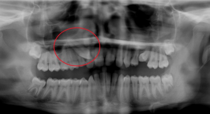 An example of adult tooth stuck under the gums