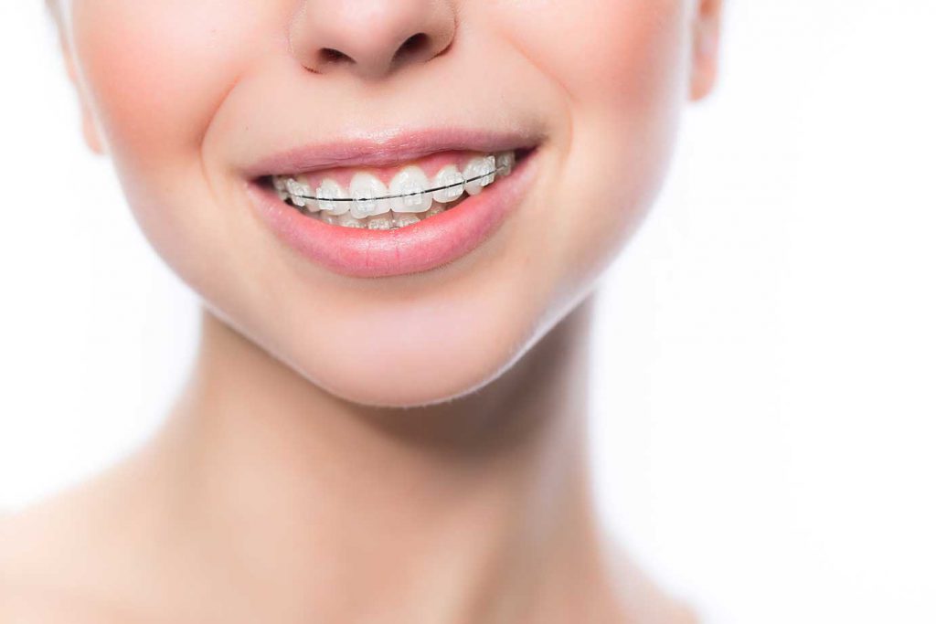 adult_braces