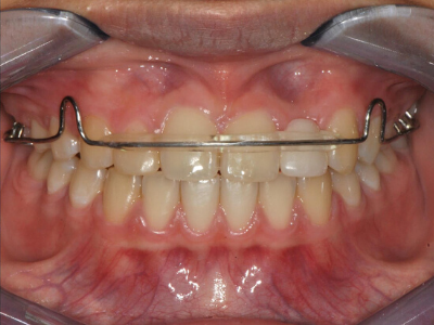 Pre-prosthetic with retainer