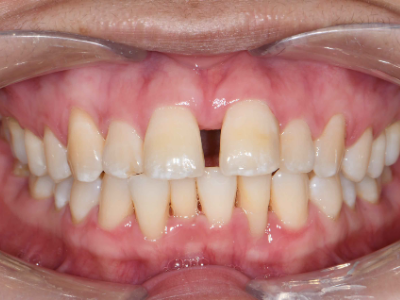 Spaced teeth